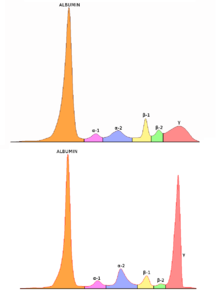 Serum protein electrophoresis of an individual with polyclonal antibodies (top) and an individual with a large paraprotein (bottom). Serum protein electrophoresis normal and paraprotein.png