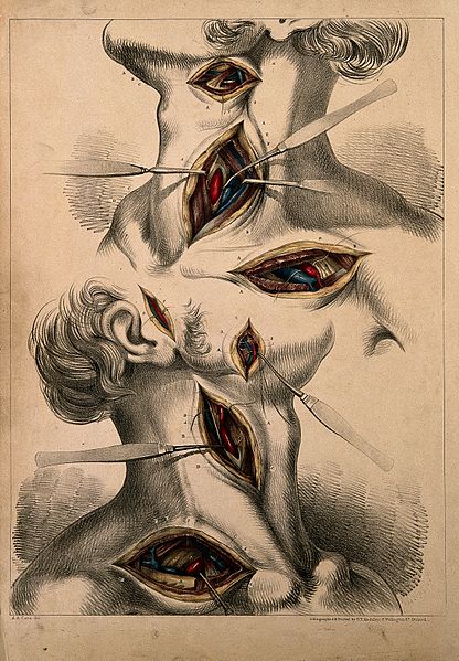 File:Surgery of carotid and subclavian arteries; two figures show Wellcome V0008156.jpg