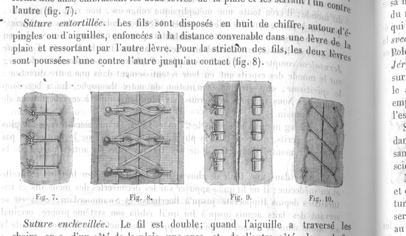 File:Types of Stitches used in sutures, from Dictionnaire Encyclopédique des Sciences Médicales (1884).png