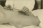 Thumbnail for File:A manual of syphilis and the venereal diseases, (1900) (14802398463).jpg