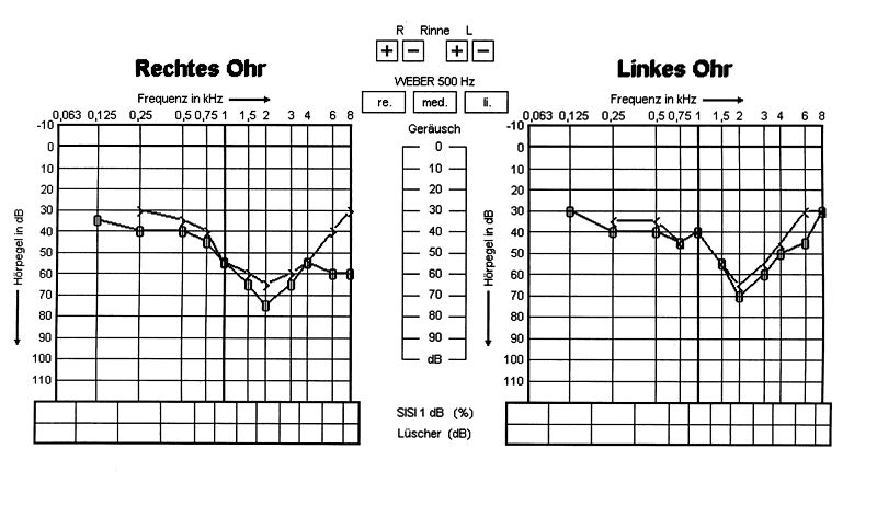 File:Alport haring loss.jpg