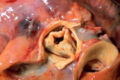 부검 시 대동맥과 관상 동맥. 오른관상동맥의 몸쪽 부분과 그 구멍이 왼쪽 아래에서 보인다.
