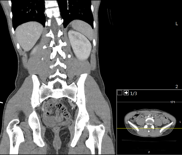 CT of a normal abdomen and pelvis, coronal plane 99.png