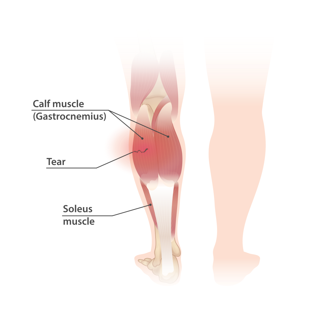 illustration of biology and medical, calf tear and Torn Calf Muscle, A torn  calf muscle is an injury that causes a partial or complete tear in the  muscles behind shin bone Stock