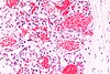 Capillary hemangioma - very high mag.jpg