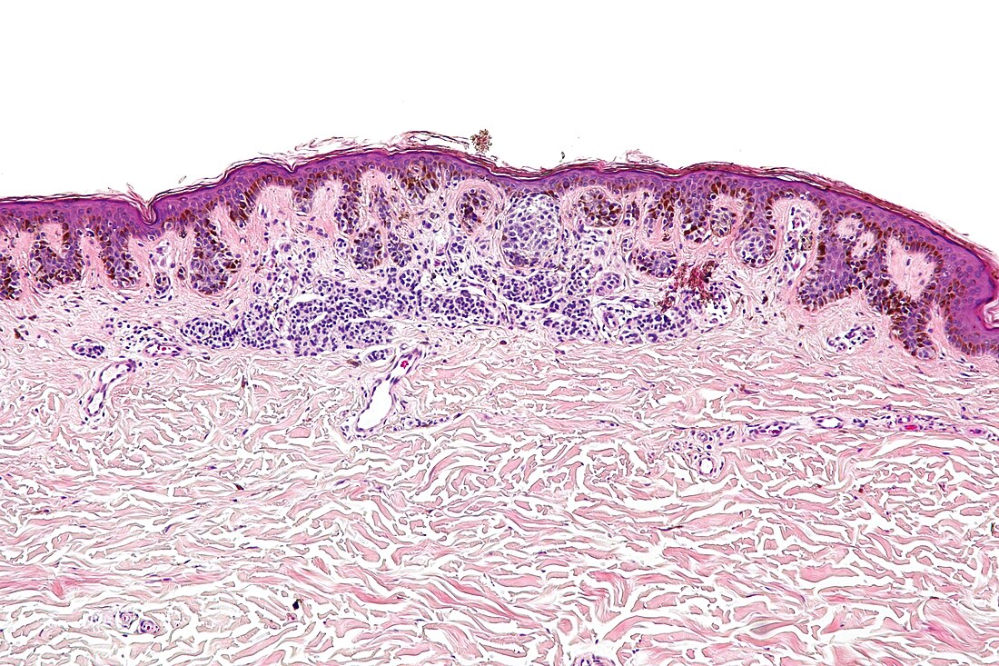 File:Dysplastic nevus - intermed mag.jpg