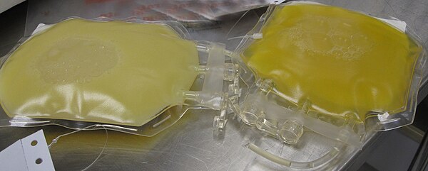 Bags of frozen plasma, from a person with hypercholesterolemia (left) and typical plasma (right)