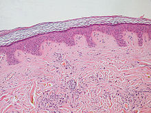 Epidermis and dermis of human skin Normal Epidermis and Dermis with Intradermal Nevus 10x.JPG