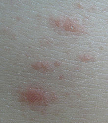 Pityriasis Rose De Gibert Wikipedia