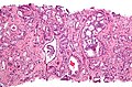 Adenokarzinom (Gleason 4)