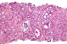 Prostate cancer with Gleason pattern 4 low mag.jpg