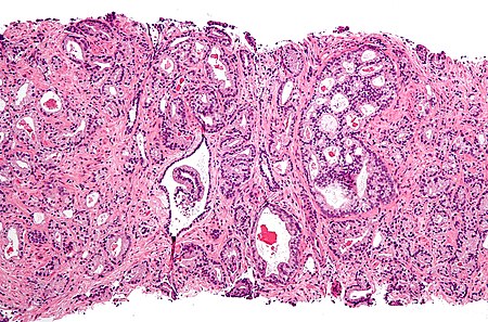 Prostate cancer with Gleason pattern 4 low mag.jpg