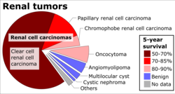 Histopathologic types of kidney tumor, with relative incidences and prognoses. Renal tumors by relative incidence and prognosis.png