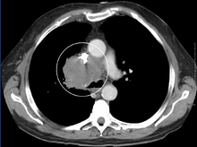 A CT image showing compression of the right hilar structures by cancer SVCCT.PNG