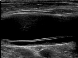 Dissection of the carotid artery on ultrasound