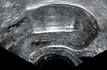 Transvaginal ultrasonography visualizing an IUD with copper in the optimal location within the uterus. Ultrasonography of IUD with copper.jpg