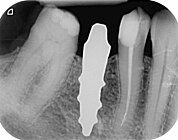 Röntgenaufnahme eines wurzelanalogen Zahnimplantats mit Einzelwurzel im rechten unteren zweiten Prämolaren