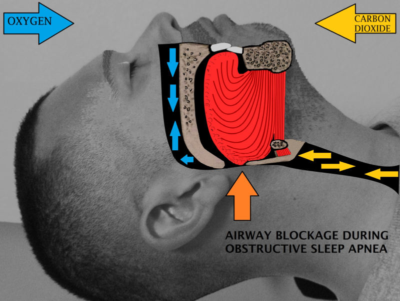 airway blockage that causes sleep apnia