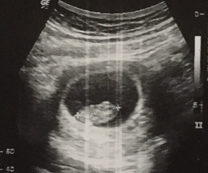 File:An Ultra-sonographic Image of Human Foetus.jpg