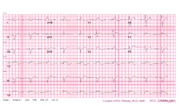 Thumbnail for File:Brugada syndrome type1 example2 (CardioNetworks ECGpedia).png