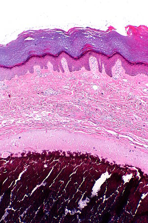 Calcinosis cutis -- low mag.jpg