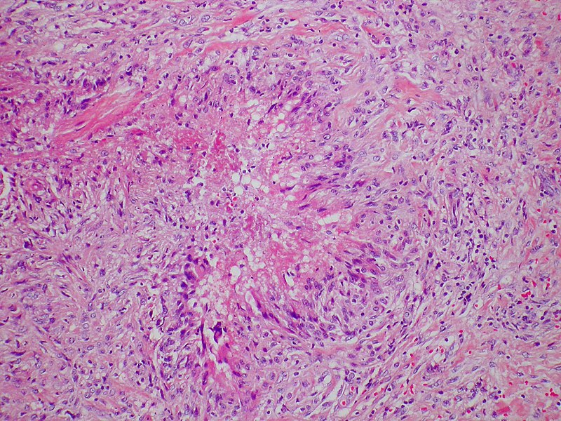 File:Candidiasis - Granulomatous (5494227334).jpg