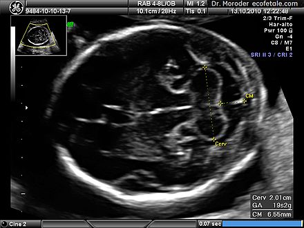 Ultrasound image of the fetal head at 19 weeks of pregnancy in a modified axial section, showing the normal fetal cerebellum and cisterna magna