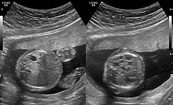 Congenital pulmonary airway malformation in a fetus, ultrasound at 19 weeks - transverse. Stomach on left image; heart on right image: displaced to right by cystic mass