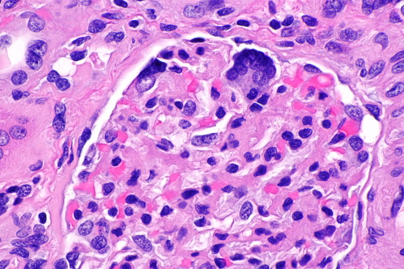 File:Cystinosis - kidney - 3 -- very high mag.jpg