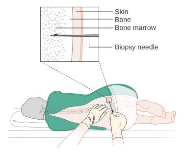 File:Diagram showing a bone marrow biopsy CRUK 051.svg