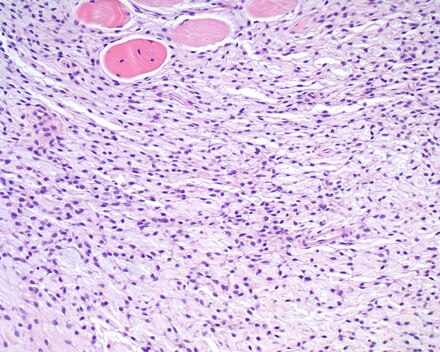 An intermediate power hematoxylin and eosin stained section of an ectomesenchymal chondromyxoid tumor, showing skeletal muscle entrapment. Note the "net-like" appearance (lower portion). Ectomesenchymal Chondromyxoid tumor LDRT 13528 High.tif