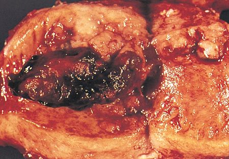 Image of the gross pathology of an endometrial adenocarcinoma