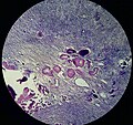 Миниатюра для Файл:Hyalinosis of ovarial vessels.jpg