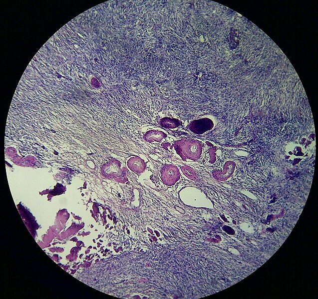 File:Hyalinosis of ovarial vessels.jpg