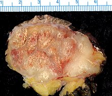 Merkel-cell carcinoma. Gross pathology specimen. Merkel Cell Carcinoma buttock 45-year-old woman.jpg