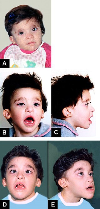 <span class="mw-page-title-main">Mowat–Wilson syndrome</span> Medical condition