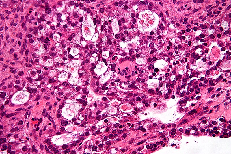 File:Ovarian clear cell carcinoma - very high mag.jpg