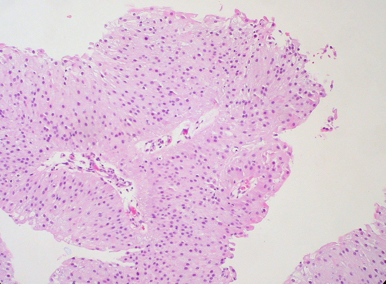 papillary urothelial low malignant potential
