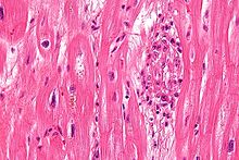 Micrograph showing an Aschoff body (right of image), as seen in rheumatic heart disease. H&E stain Rheumatic heart disease - 3a - very high mag.jpg