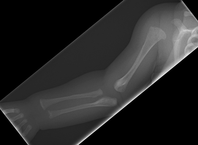 File:X-ray of osteogenesis imperfecta type 5 in newborn - right arm.jpg