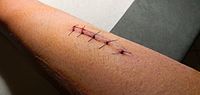 Suture, à mon avant-bras droit.