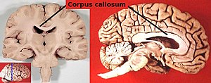 Corpus callosum.jpg