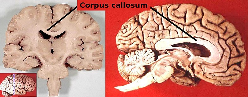 corpus callosum diagram