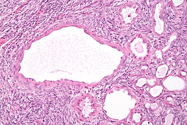 High magnification micrograph of a cystic nephroma showing the characteristic simple epithelium with hobnail morphology, and the ovarian-like stroma. H&E stain. Cystic nephroma high mag.jpg