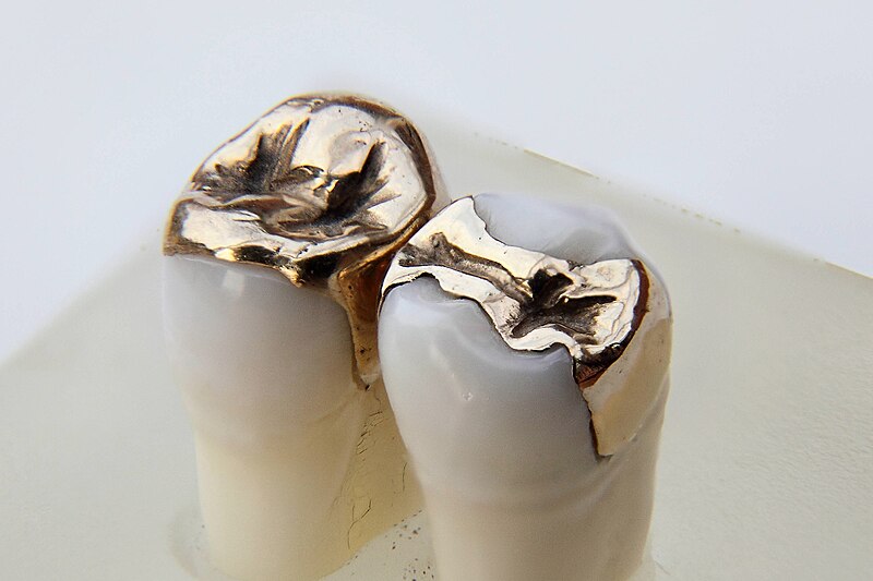 File:Dental inlays Gold Focus stacking with freeware CombineZP 12 04.jpg