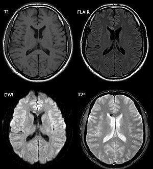 Diffuse axonal injury after a motorcycle accident. MRI after 3 days: on T1-weighted images the injury is barely visible. On the FLAIR, DWI and T2*-weighted images a small bleed is identifiable.