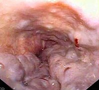 Esophageal varices - wale.jpg