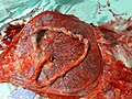 Fetal side of same placenta