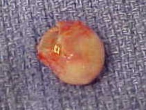 Trichilemmalcyst.JPG 