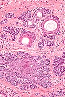 Micrograph of a trichoepithelioma. H&E stain.